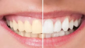 کیت سفید کننده دندان + راهنمای خرید